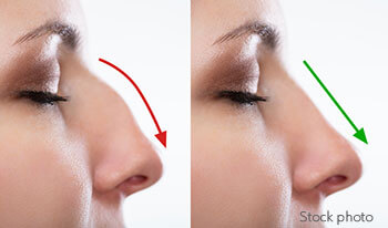 Rhinoplasty nose shaping