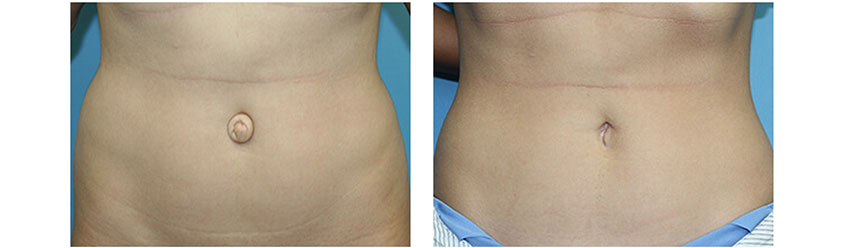 Umbilicoplasty before and after photos