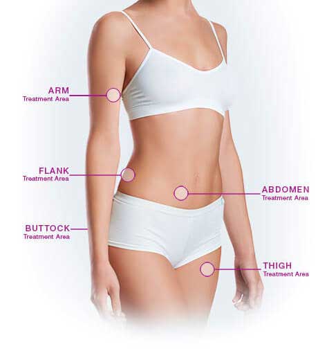 VelaShape treatment areas